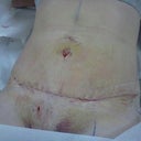 Love my belley Post op day 7