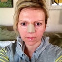 Day after surgery (Saturday after Friday's procedure)