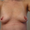 One week post op