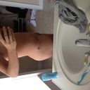 17 days post-op