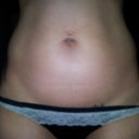 Day 1 - right before coolsculpt