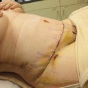 Day 5 - post op - side view
