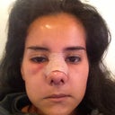 A day after surgery