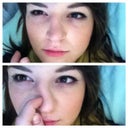 Pre-Op. eyes are no longer swollen and nose feels fine but its clearly crooked.