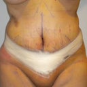 post op day 4 front