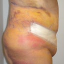 post op day 4 side