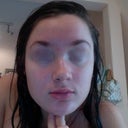 My face during the 6th week. A couple pimples but nothing severe. Red marks still present but not terrible, hopefully they're in the process of fading. Satisfied thus far that the worst is over.