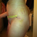 PO Day 5 - Lipo bruises