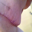 Swelling