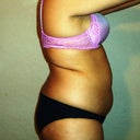 pre- op 2wks
