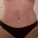 tummy 3 months post op