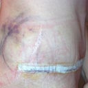 2 days post-op Revision