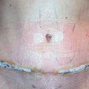2 days post-op Revision