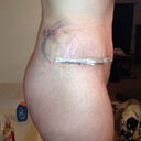 2 days post-op Revision