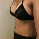 After - 350 cc silicone under.  Tummy nice and flat.  Marks are from ab binder.