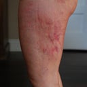 left lateral thigh, 2 days post procedure