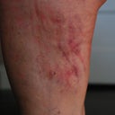 close up left thigh