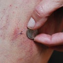incision mark, please ignore bad manicure!!