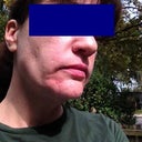 Dreaded sunshine shot. Right side, worse side. Awful around the corner of my mouth.