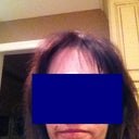 This is two days after subcision (the second session). No makeup.
