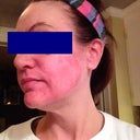 One day after laser (third treatment). No Makeup.