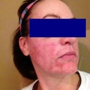 Note the white streaks you get because they work in sections. You can kind of see the extra-red spots from subcision.No makeup.