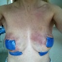 2nd day, very bruised