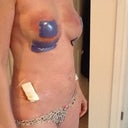 2nd day of removal and fat tansfer
