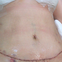 This is a pic of my tummy tuck cut 5 days post op. I love the incision cuz its thin and low to my pubic area and a cute happy smile which will be well hidden in my bikini's. I luv my belly button as well. But the best part is that it looks like a natural tummy and not like my first tummy tuck which the skin looked supper streched.