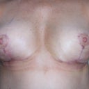 17 days post-op