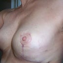 17 days, some scars but i know that they will become paler and paler over time