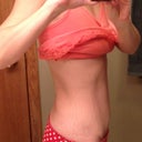 24 Days Postop - Just a little swelling above the incision on this side.
