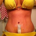 1 week post op! I have curves again, and I can see a little ab definition showing through.