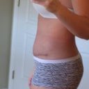 Three week PO side view. Just a little puffy.