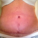Three weeks PO. Can you see the slit under my bb?  Hate it!  Hope he can fix that for me!  Ugh.
