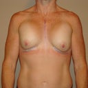 Night after surgery