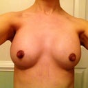 Post op day 15