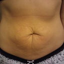 7 days before surgery!