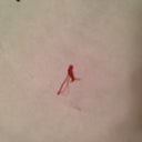 Stitch that came out of my BB at 4 weeks.