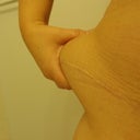 flank area on right side not corrected during extended tummy tuck an lipo