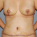 After: day 8, front view still pretty swollen, and that operative marker is stubborn!
