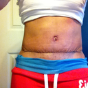 post op day 13