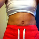 post op day 13