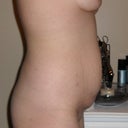 Right side pre-op