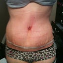 Week 2 Post-op.  Taken in the afternoon.    Puffy below the BB.