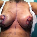 day of surgery