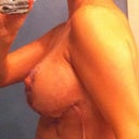 sweet boobies!!!  I love them!!!!  (with my drain tube)