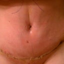 4 days post-op