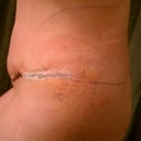 4 days post-op side view see the swelling