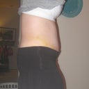 Patch on side is a silicon strip that I only wear on sides since the front still has some scabbing.